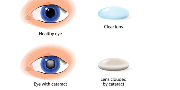 Post operative lasik care