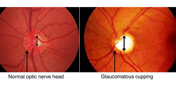 Post operative lasik care